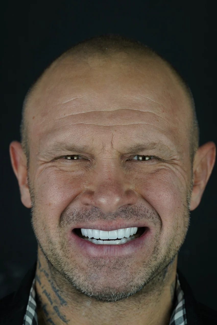 piotr piechowiak teeth after lema