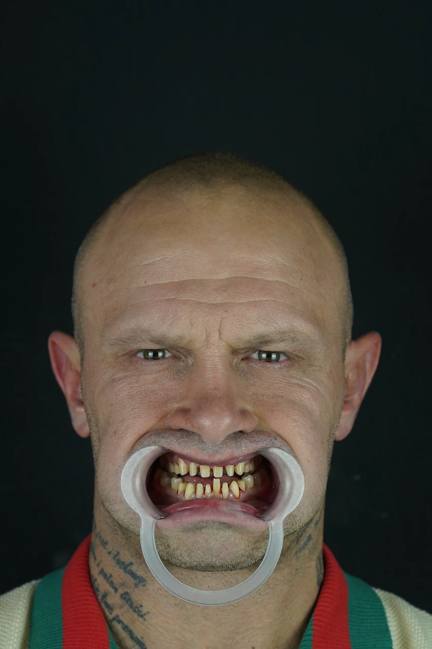 piotr piechowiak teeth before lema