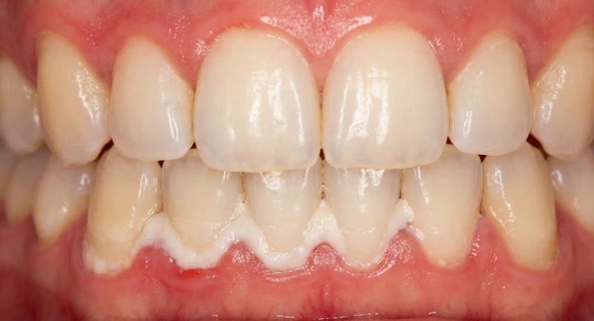 plaque buildup along lower gumline