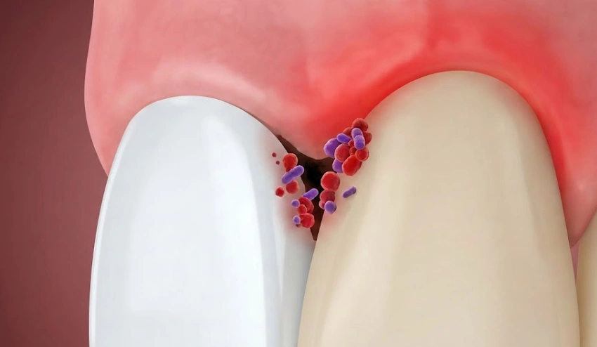 poorly-fitted-veneer-trapping-bacteria