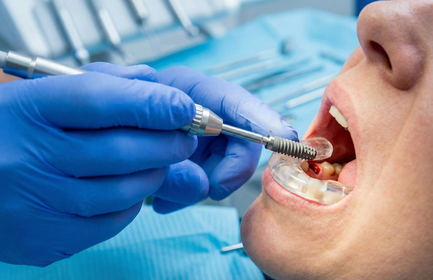 specjalistyczny zabieg wszczepienia implantu tytanowego