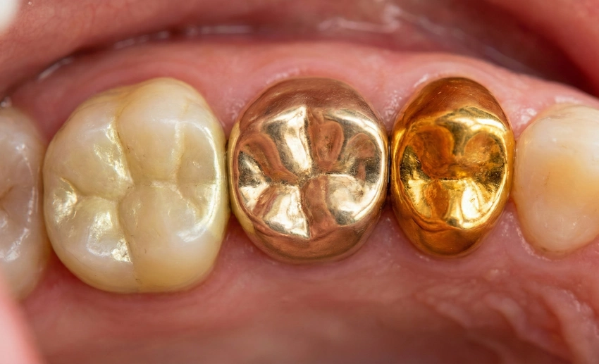 πραγματικές χρυσές οδοντογλυφίδες 14k 18k 22k σε κοντινή λήψη