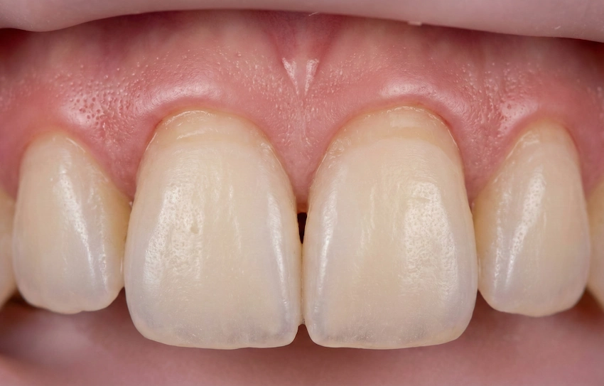 receding gums veneers preparation closeup