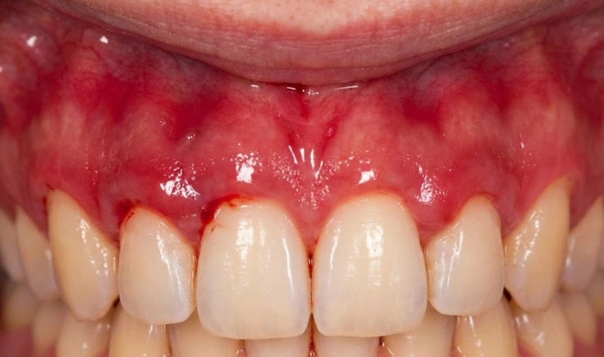 gingivitis severa con encías inflamadas y sangrantes