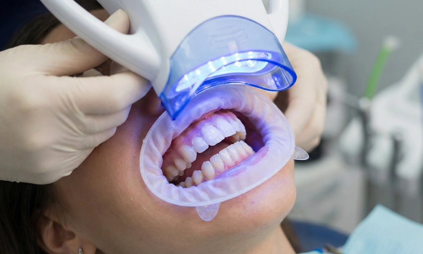 teeth whitening before dental jewelry procedure