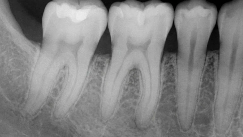 x-ray revealing bone loss from gum disease
