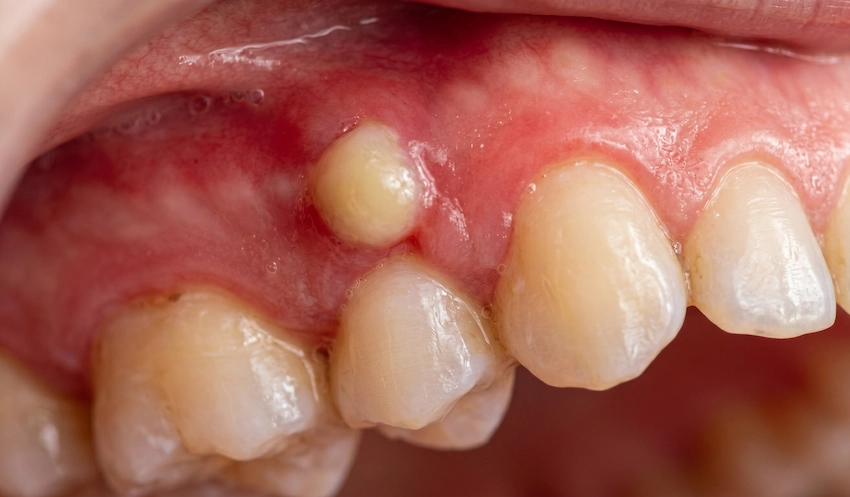 symptômes d'abcès de la gencive