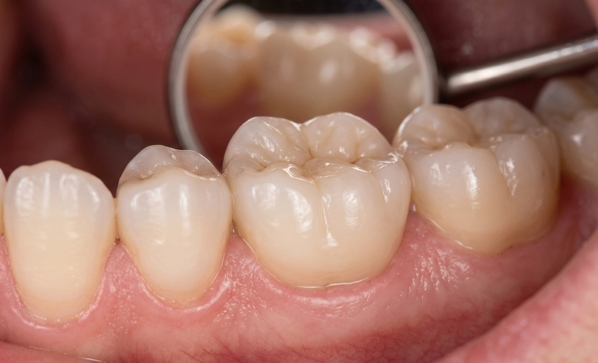 Feilloze kroon na wortelkanaalbehandeling