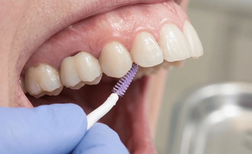 cómo usar super floss con enhebrador debajo del puente dental