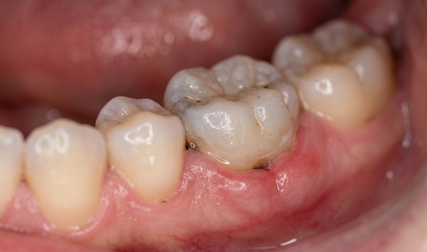 infected tooth gum swelling macro