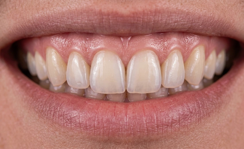 fără gingivectomie fațete din laminat zâmbet natural perfect turcia