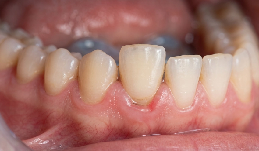 symptômes de la maladie parodontale dents desserrées istanbul turquie