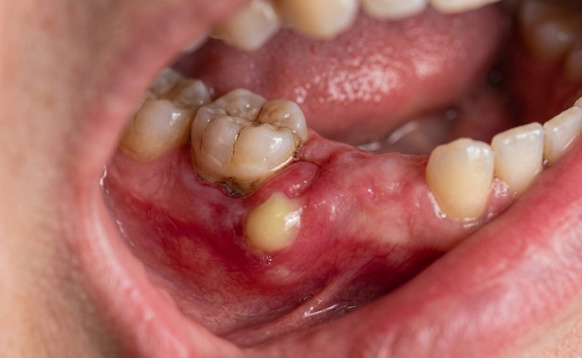 dettagli infezione ascesso dentale non trattato