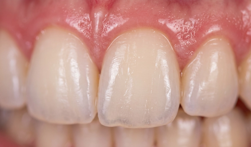 close up unblemished female smile after tooth gem removal