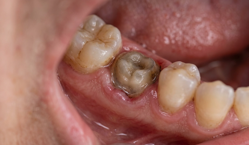 failed dental crown site missing tooth decayed root