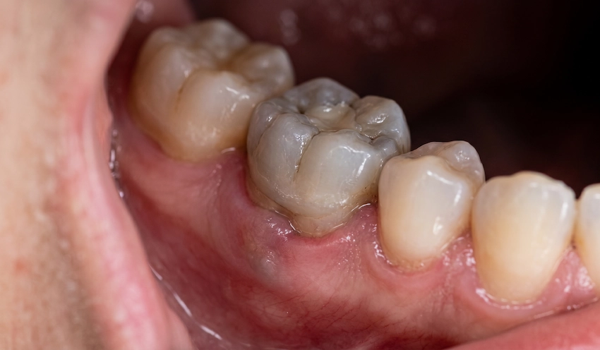 failed root canal tooth infection gum swelling