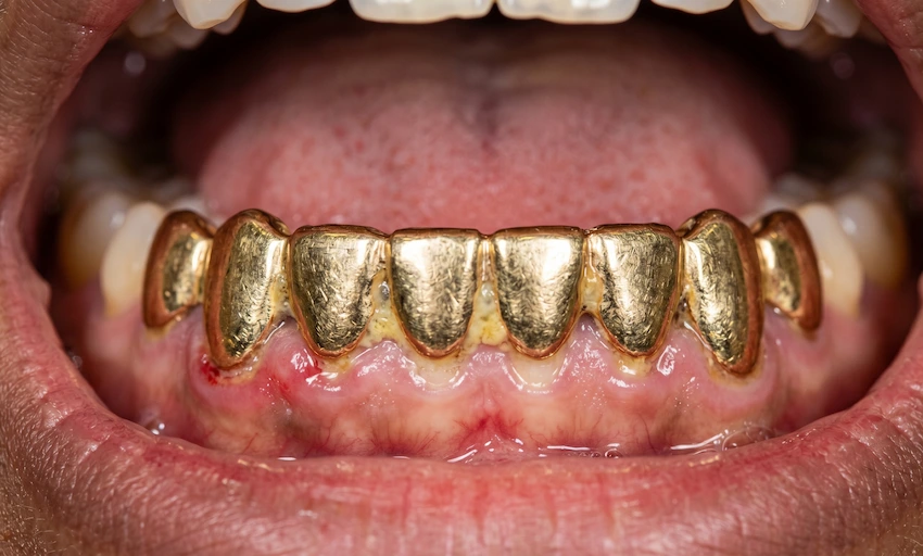 gold dental grillz plaque buildup gum inflammation