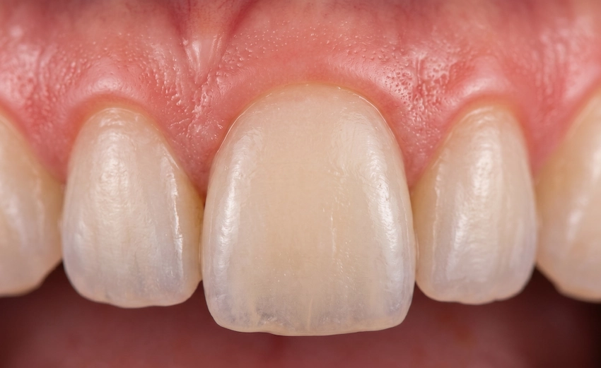 gengive rosa sane corona dentale in zirconia