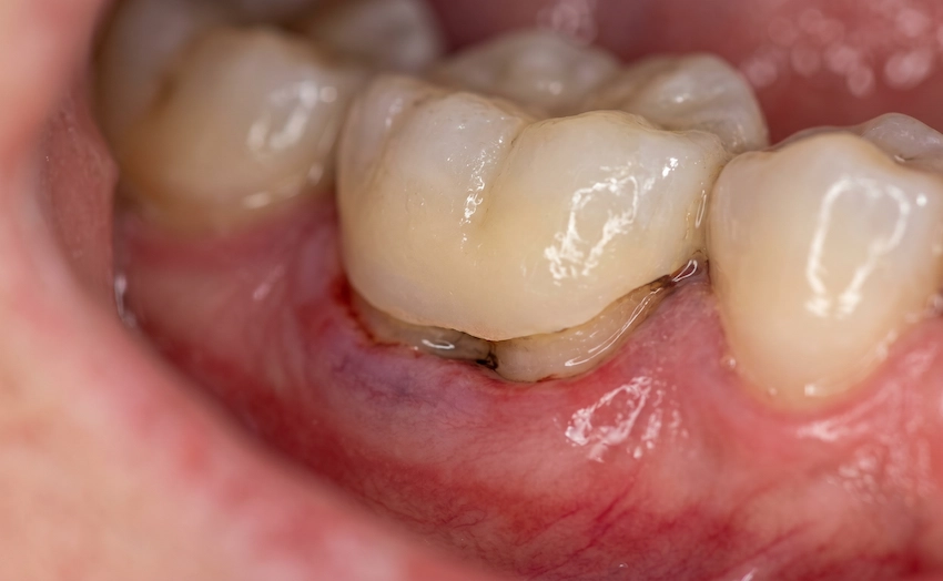 ill fitting dental crown gum inflammation