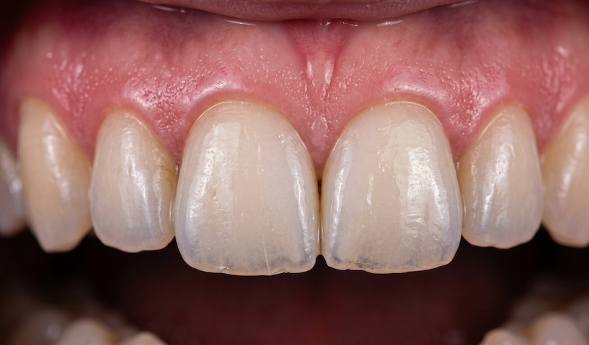 long lasting porcelain veneers macro lema dental turkey