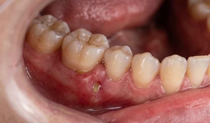 macrophotography ruptured dental abscess infected gum pre molar