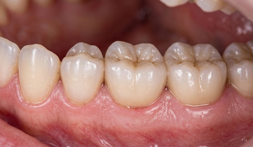 modern ceramic dental crowns