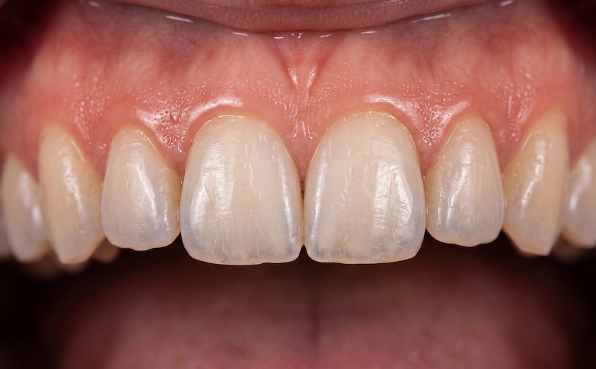 upper teeth gums close up