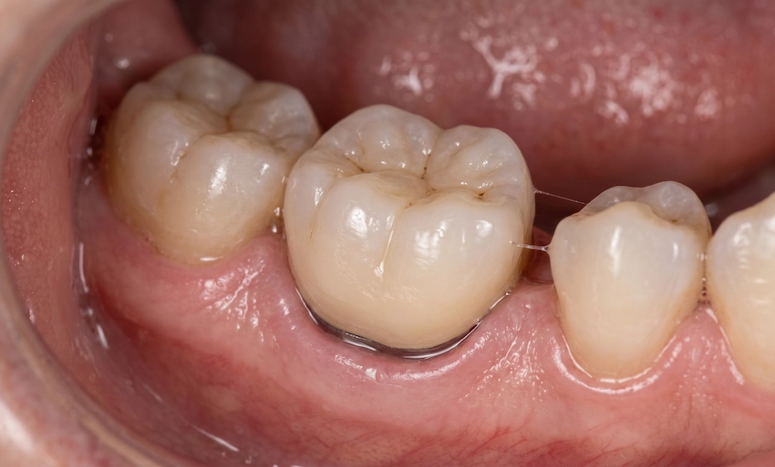 zirconia implant crown healthy gums