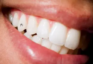 can you use denture adhesive for tooth gems a clinical reality