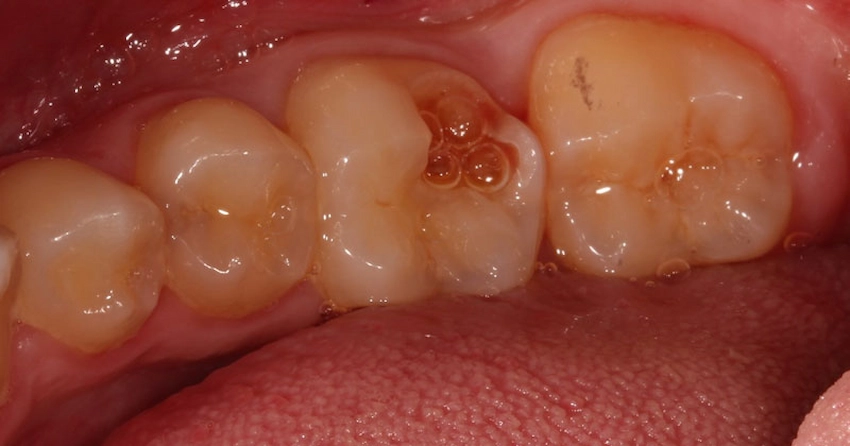 direct pulp capping biocompatible liner application lema clinic