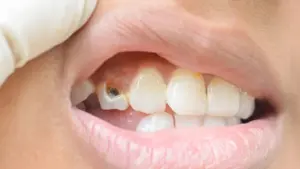 how to save a dead tooth causes symptoms and prevention