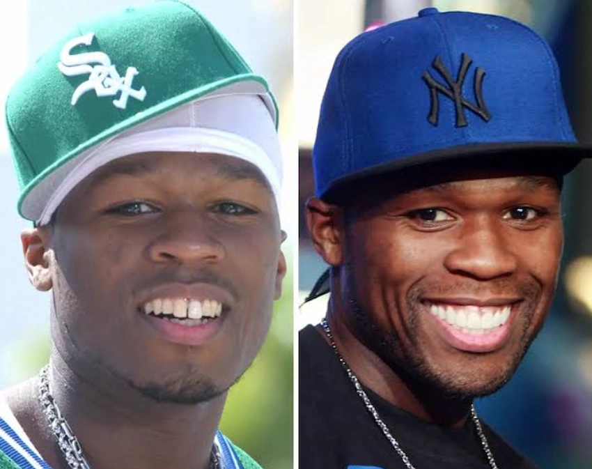 50 cent teeth before after