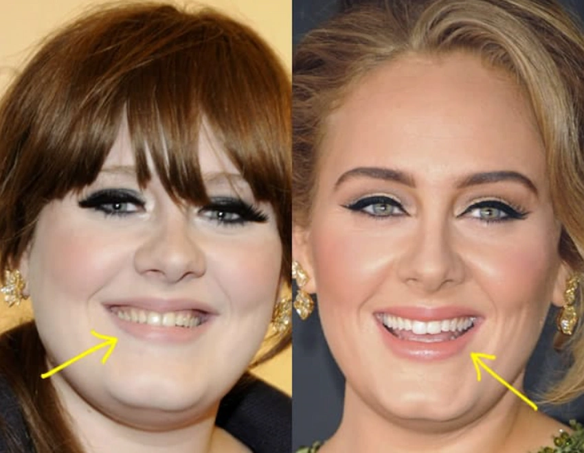 adele teeth before after