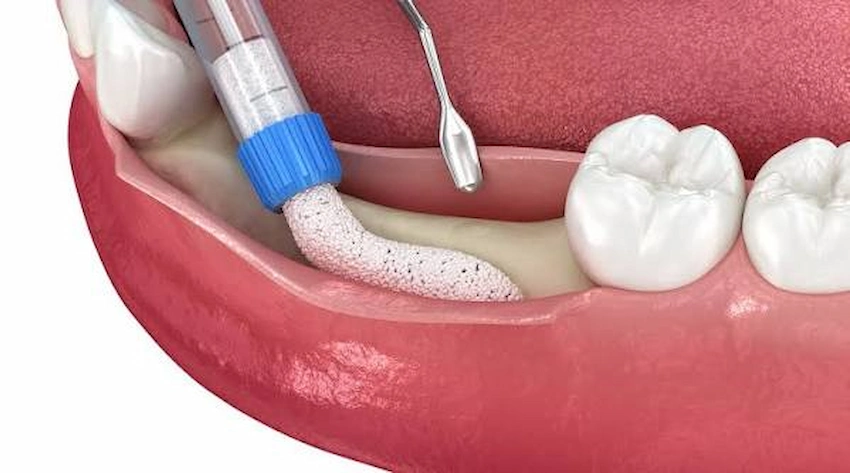 alveoloplasty bone smoothing procedure