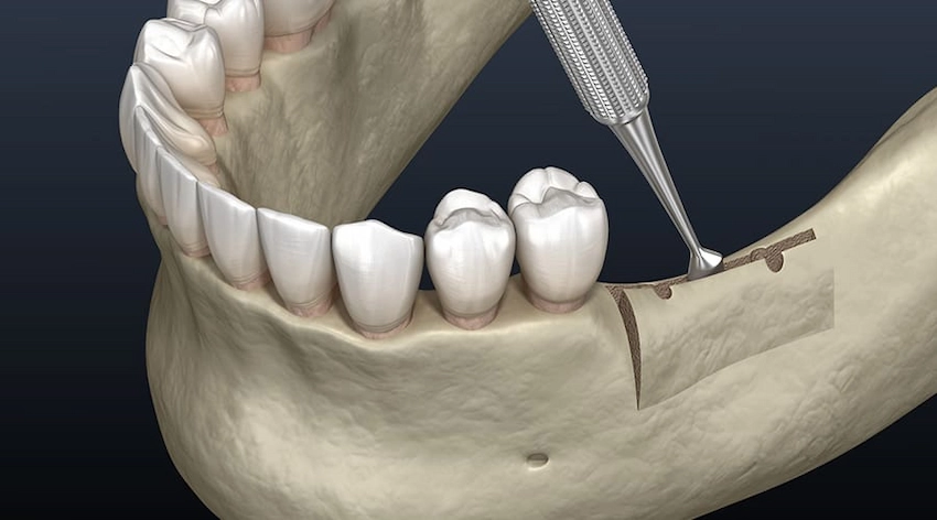 alveoloplasty jawbone reshaping diagram