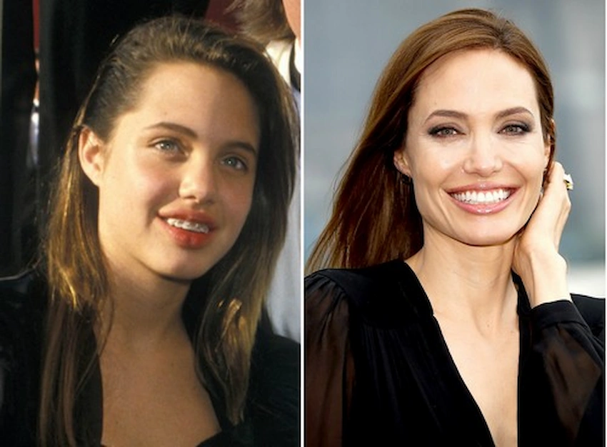 angelina jolie teeth before after