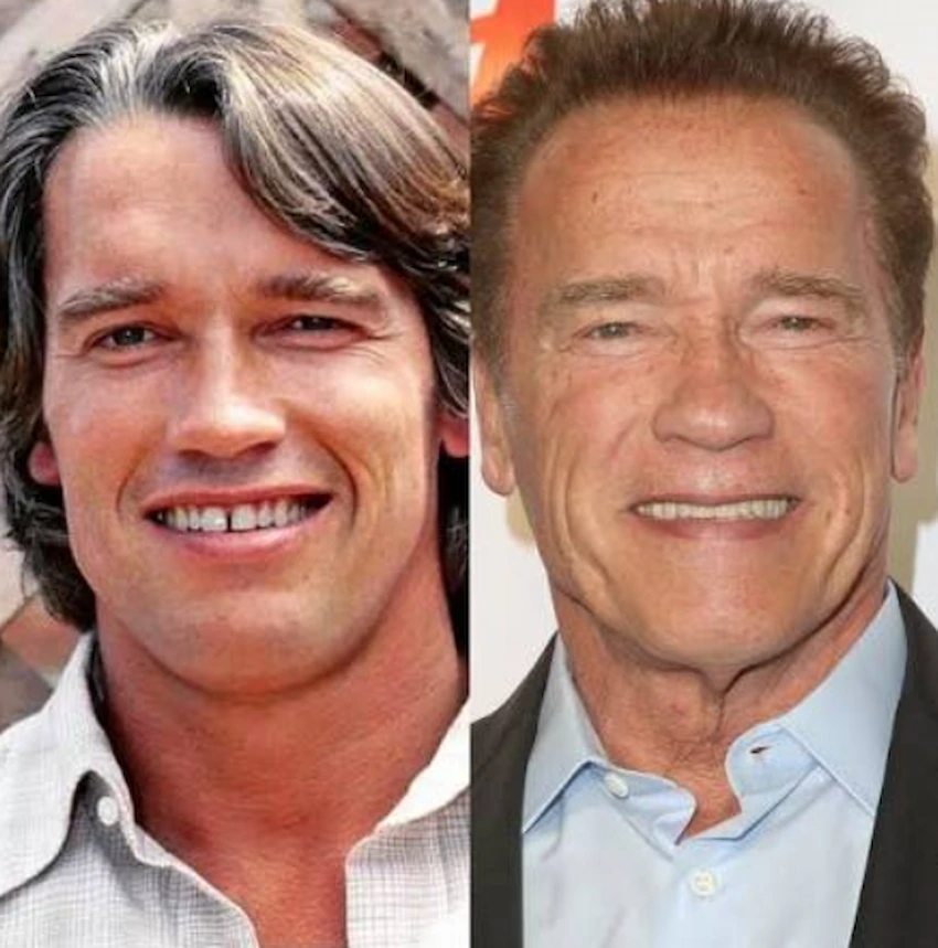 arnold schwarzenegger teeth before after