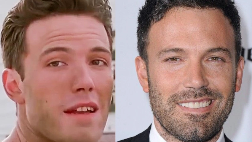 ben affleck teeth before after ben affleck teeth before after