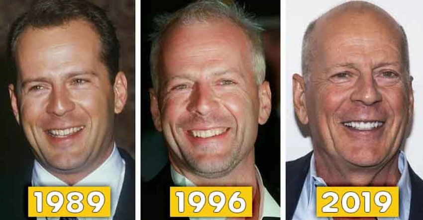 bruce willis teeth before after