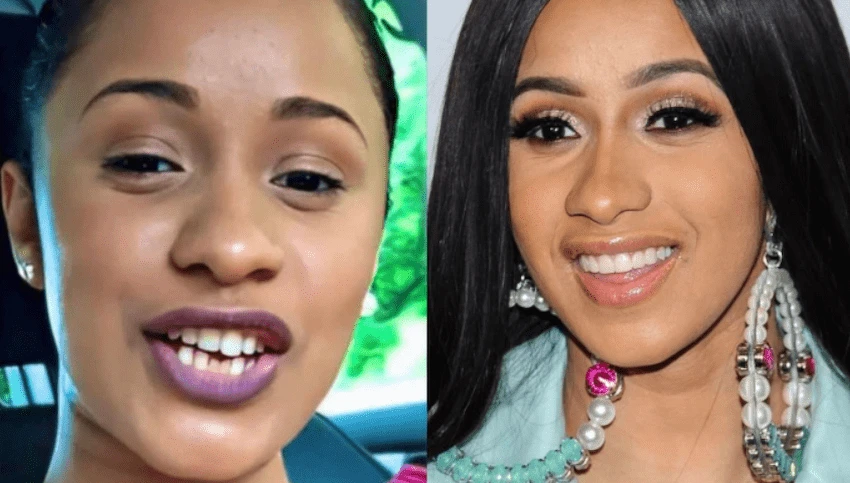 cardi b teeth before after cardi b teeth before after
