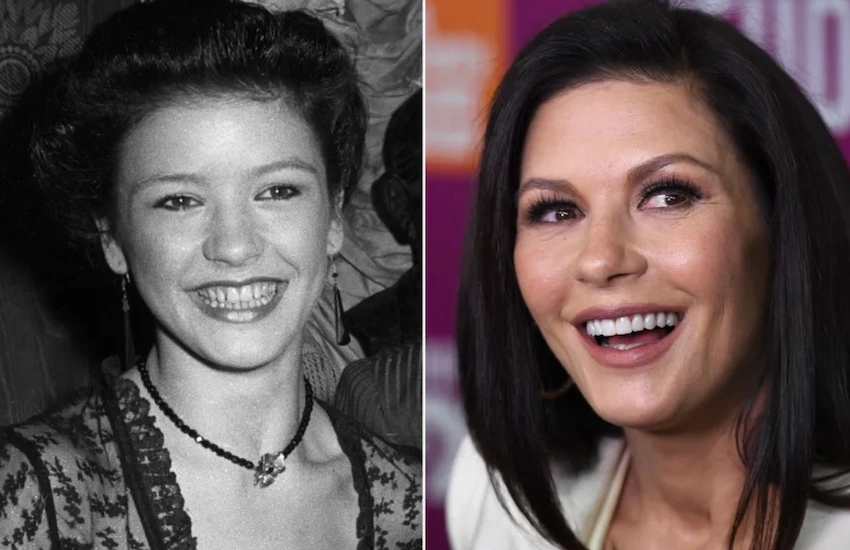 catherine zeta jones teeth before after