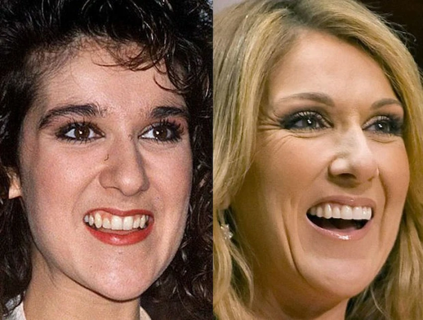 celine dion before after teeth