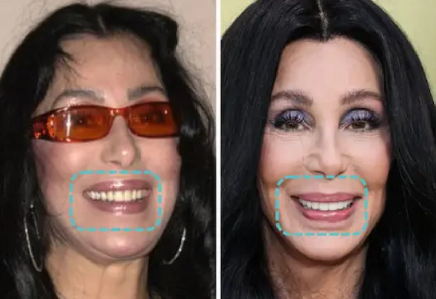 cher teeth before after