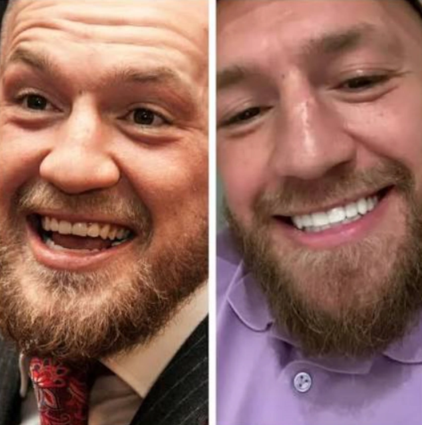conor mcGregor teeth before after