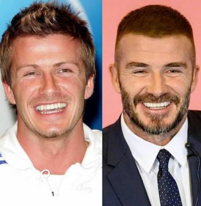 david beckham teeth before after