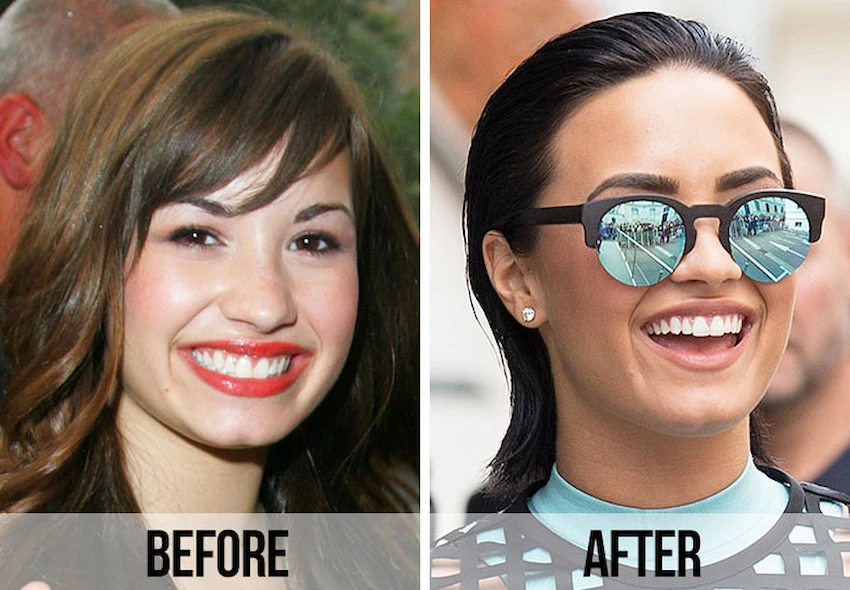 demi Lovato celebrities teeth before after (1)