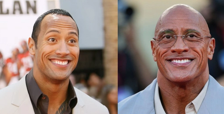 dwayne johnson teeth before after