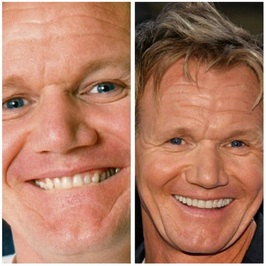 gordon ramsay teeth before after