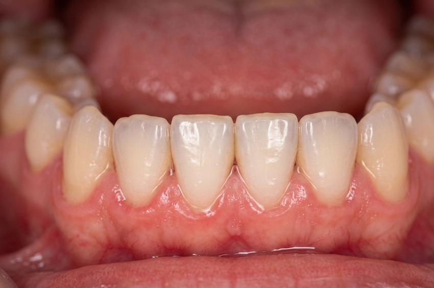 healthy gums prevent dry mouth