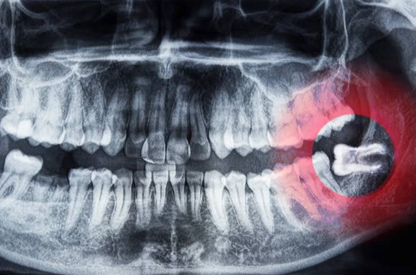 how long does wisdom teeth recovery take a simple guide